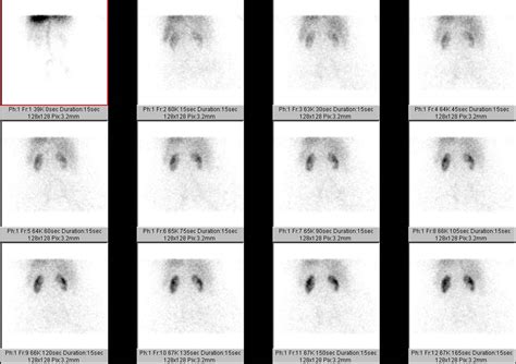 Nuclear Renal Scan .